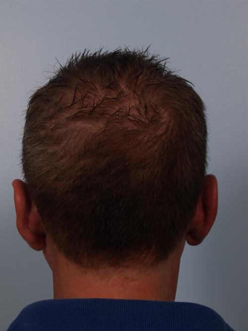 Otoplasty (Ear Reshaping) After Photo | Phoenix and Scottsdale, AZ | Scottsdale Center for Plastic Surgery