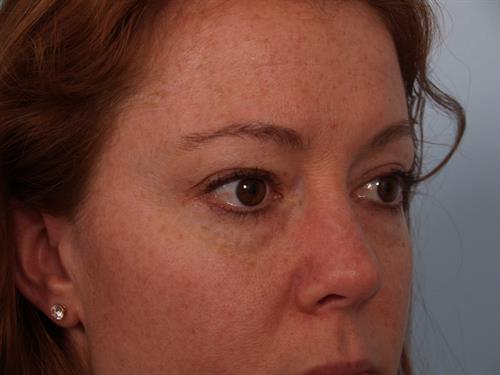 Eyelid Surgery Before Photo | Phoenix and Scottsdale, AZ | Scottsdale Center for Plastic Surgery
