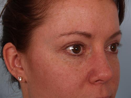 Eyelid Surgery After Photo | Phoenix and Scottsdale, AZ | Scottsdale Center for Plastic Surgery