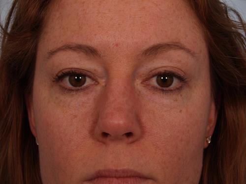 Eyelid Surgery Before Photo | Phoenix and Scottsdale, AZ | Scottsdale Center for Plastic Surgery