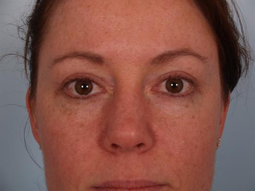 Eyelid Surgery After Photo | Phoenix and Scottsdale, AZ | Scottsdale Center for Plastic Surgery