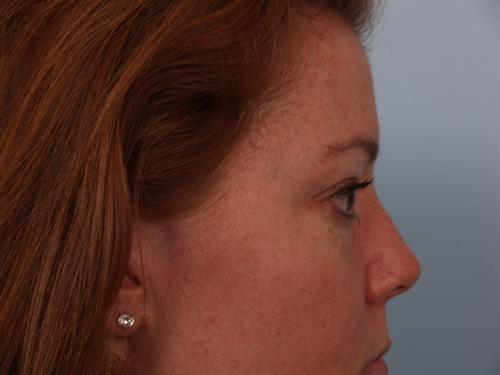 Eyelid Surgery Before Photo | Phoenix and Scottsdale, AZ | Scottsdale Center for Plastic Surgery