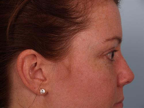 Eyelid Surgery After Photo | Phoenix and Scottsdale, AZ | Scottsdale Center for Plastic Surgery