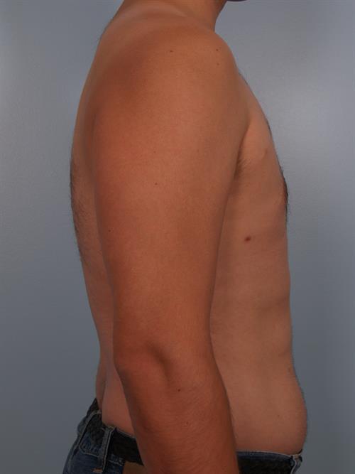 Male Breast/Areola Reduction After Photo | Phoenix and Scottsdale, AZ | Scottsdale Center for Plastic Surgery