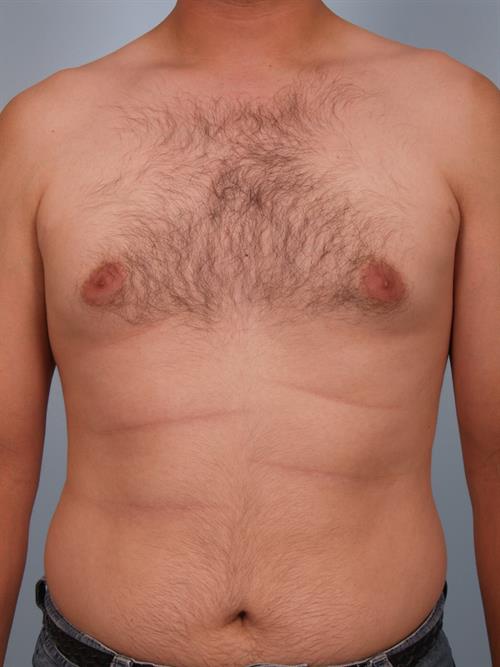 Male Liposuction Before Photo | Phoenix and Scottsdale, AZ | Scottsdale Center for Plastic Surgery