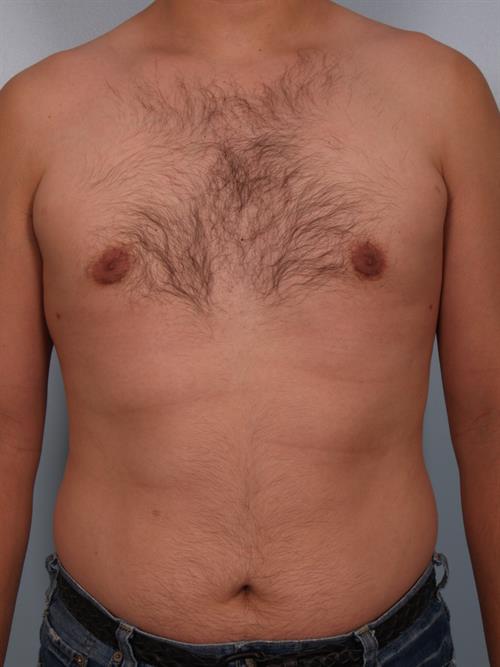 Male Liposuction After Photo | Phoenix and Scottsdale, AZ | Scottsdale Center for Plastic Surgery