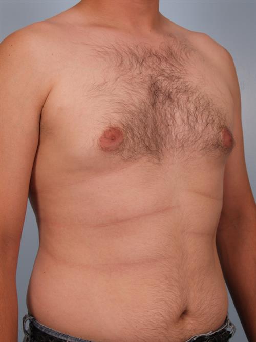Male Breast/Areola Reduction Before Photo | Phoenix and Scottsdale, AZ | Scottsdale Center for Plastic Surgery
