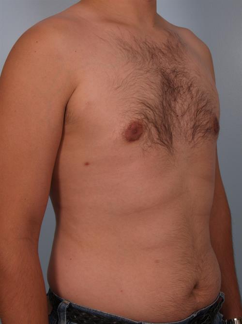 Male Breast/Areola Reduction After Photo | Phoenix and Scottsdale, AZ | Scottsdale Center for Plastic Surgery