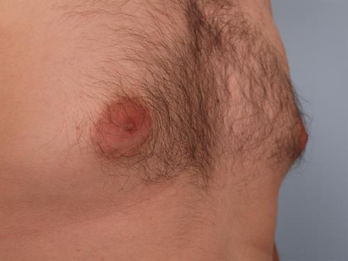 Male Breast/Areola Reduction Before Photo | Phoenix and Scottsdale, AZ | Scottsdale Center for Plastic Surgery