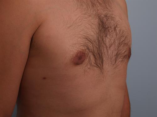 Male Breast/Areola Reduction After Photo | Phoenix and Scottsdale, AZ | Scottsdale Center for Plastic Surgery