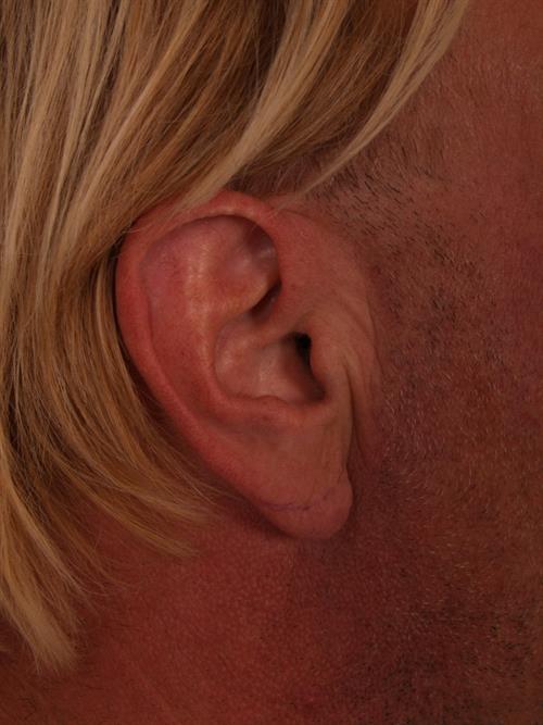 Otoplasty (Ear Reshaping) Before Photo | ,  | 
