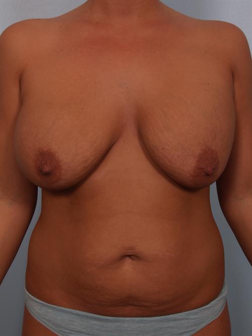 Revision Breast Surgery Before Photo | Phoenix and Scottsdale, AZ | Scottsdale Center for Plastic Surgery