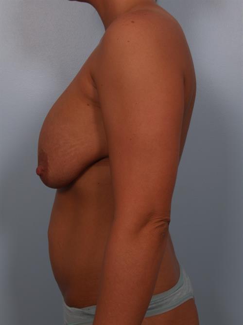 Revision Breast Surgery Before Photo | Phoenix and Scottsdale, AZ | Scottsdale Center for Plastic Surgery