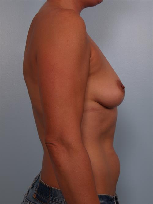 Breast Lift (Mastopexy) Before Photo | Phoenix and Scottsdale, AZ | Scottsdale Center for Plastic Surgery