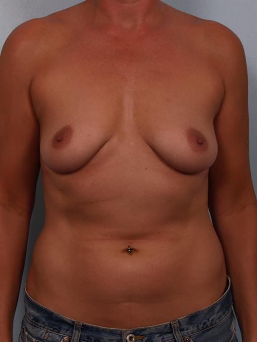 Breast Lift (Mastopexy) Before Photo | Phoenix and Scottsdale, AZ | Scottsdale Center for Plastic Surgery