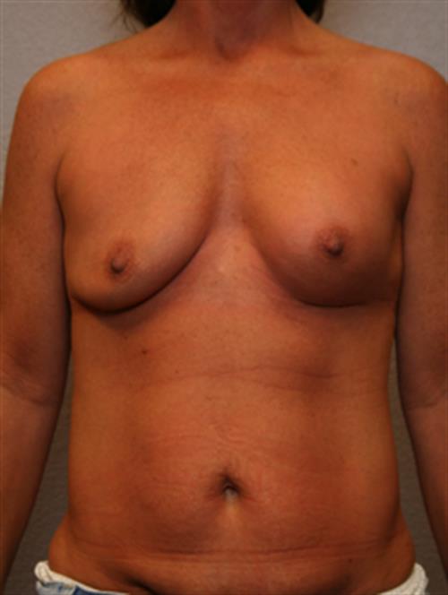 Breast Augmentation (Corrective) Before Photo | Phoenix and Scottsdale, AZ | Scottsdale Center for Plastic Surgery