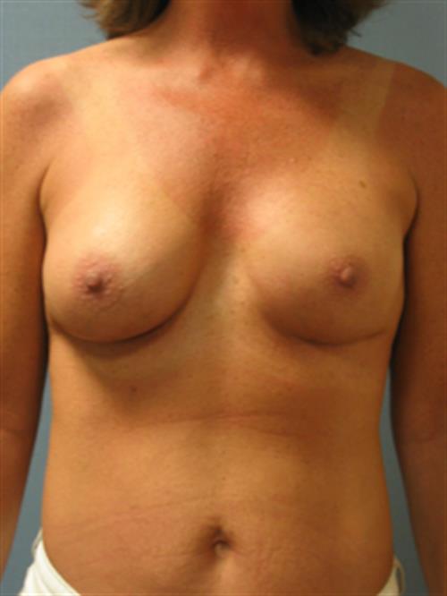 Breast Augmentation (Corrective) After Photo | Phoenix and Scottsdale, AZ | Scottsdale Center for Plastic Surgery