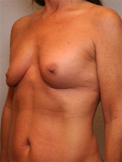 Revision Breast Surgery Before Photo | Phoenix and Scottsdale, AZ | Scottsdale Center for Plastic Surgery