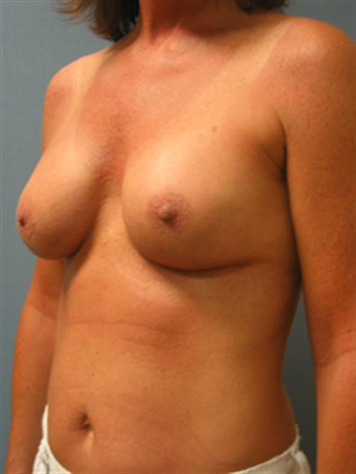 Revision Breast Surgery After Photo | Phoenix and Scottsdale, AZ | Scottsdale Center for Plastic Surgery