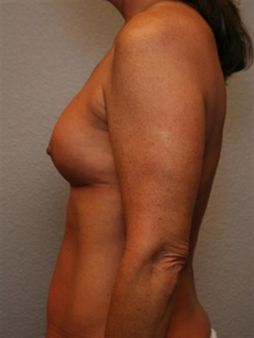 Revision Breast Surgery Before Photo | Phoenix and Scottsdale, AZ | Scottsdale Center for Plastic Surgery