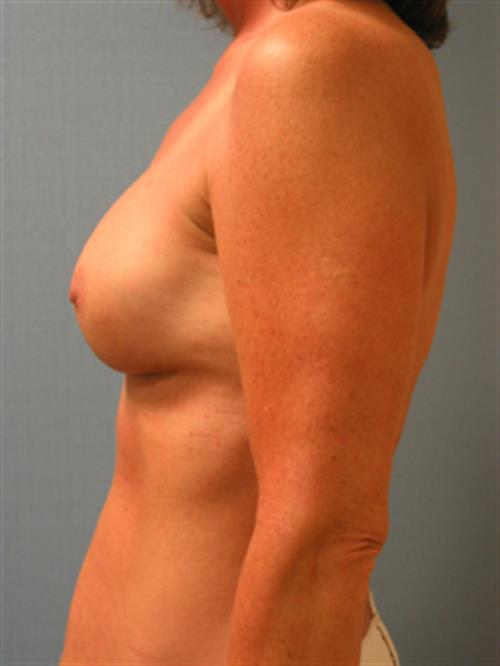 Revision Breast Surgery After Photo | Phoenix and Scottsdale, AZ | Scottsdale Center for Plastic Surgery