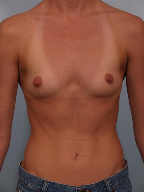 Breast Augmentation Before Photo | Phoenix and Scottsdale, AZ | Scottsdale Center for Plastic Surgery