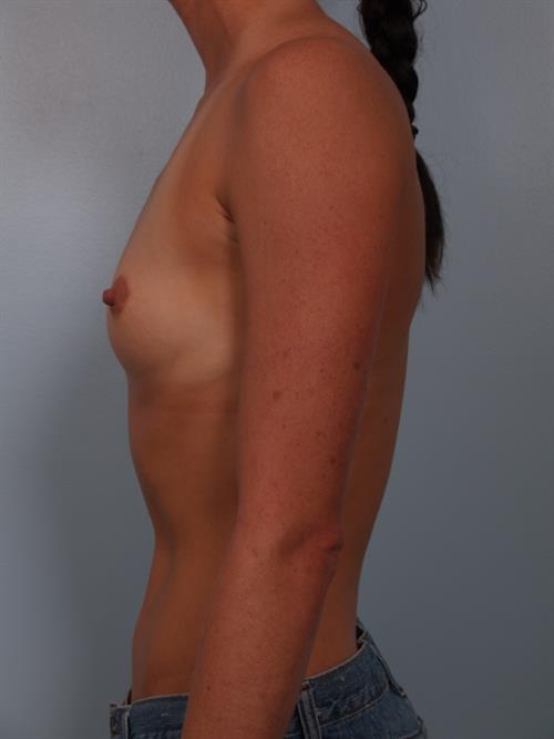 Breast Augmentation Before Photo | Phoenix and Scottsdale, AZ | Scottsdale Center for Plastic Surgery