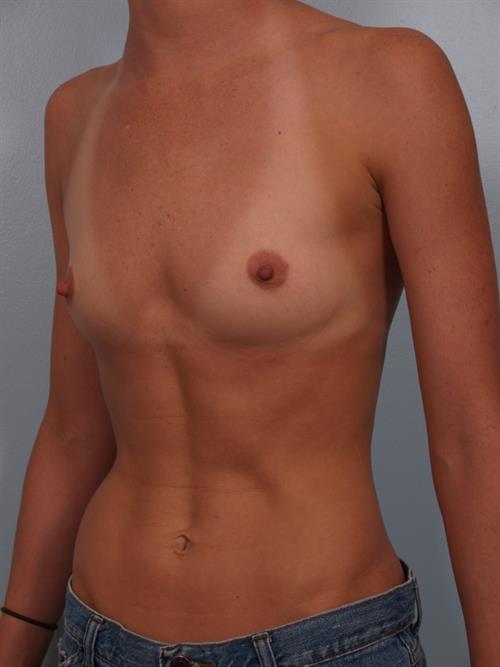 Breast Augmentation Before Photo | Phoenix and Scottsdale, AZ | Scottsdale Center for Plastic Surgery