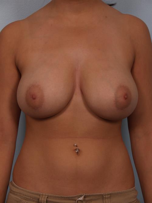 Breast Reduction Before Photo | Phoenix and Scottsdale, AZ | Scottsdale Center for Plastic Surgery