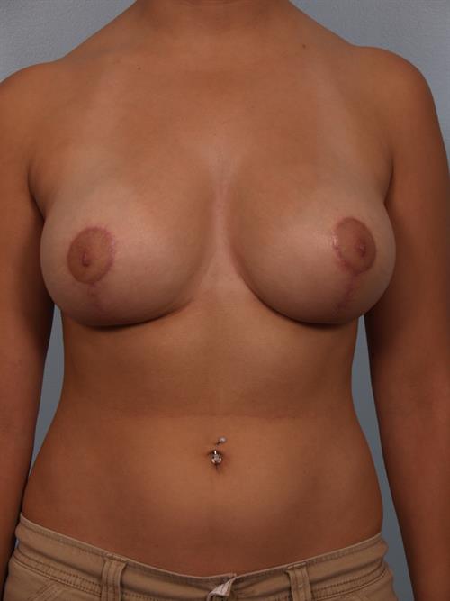 Breast Reduction After Photo | Phoenix and Scottsdale, AZ | Scottsdale Center for Plastic Surgery