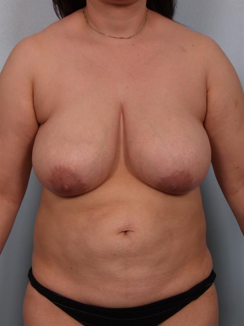 Breast Reduction Before Photo | Phoenix and Scottsdale, AZ | Scottsdale Center for Plastic Surgery