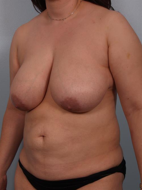 Breast Reduction Before Photo | Phoenix and Scottsdale, AZ | Scottsdale Center for Plastic Surgery