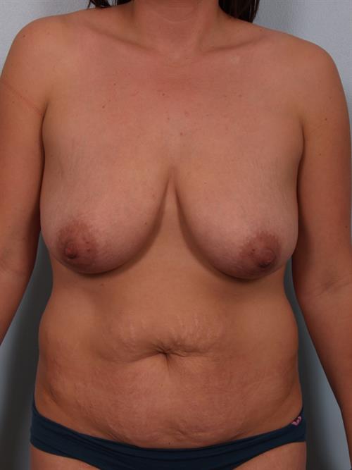 Power Assisted Liposuction Before Photo | Phoenix and Scottsdale, AZ | Scottsdale Center for Plastic Surgery