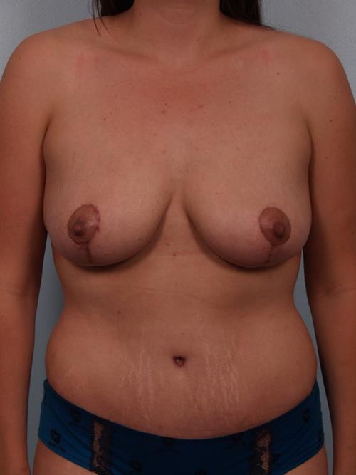 Power Assisted Liposuction After Photo | Phoenix and Scottsdale, AZ | Scottsdale Center for Plastic Surgery