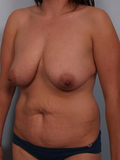 Power Assisted Liposuction Before Photo | Phoenix and Scottsdale, AZ | Scottsdale Center for Plastic Surgery