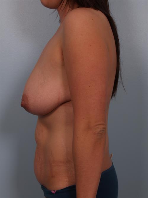 Power Assisted Liposuction Before Photo | Phoenix and Scottsdale, AZ | Scottsdale Center for Plastic Surgery