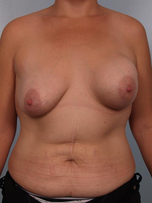 Revision Breast Surgery Before Photo | Phoenix and Scottsdale, AZ | Scottsdale Center for Plastic Surgery