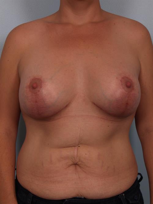 Revision Breast Surgery After Photo | Phoenix and Scottsdale, AZ | Scottsdale Center for Plastic Surgery
