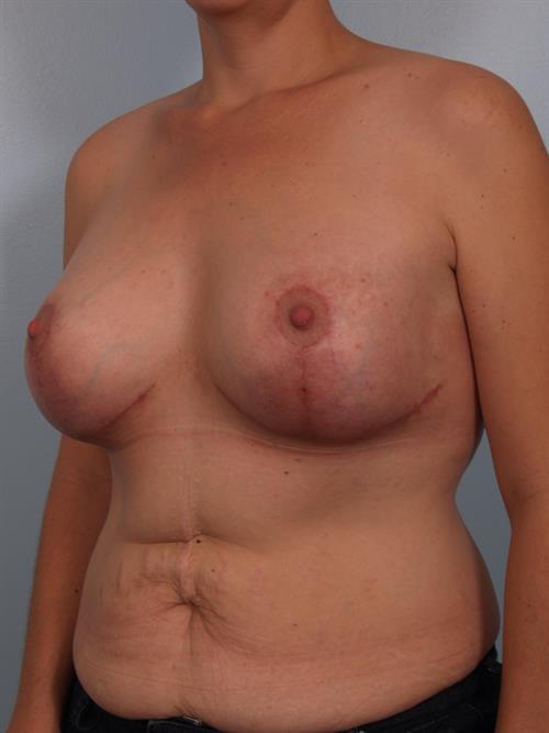 Revision Breast Surgery After Photo | Phoenix and Scottsdale, AZ | Scottsdale Center for Plastic Surgery