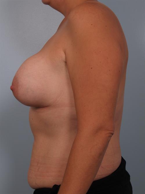 Revision Breast Surgery Before Photo | Phoenix and Scottsdale, AZ | Scottsdale Center for Plastic Surgery