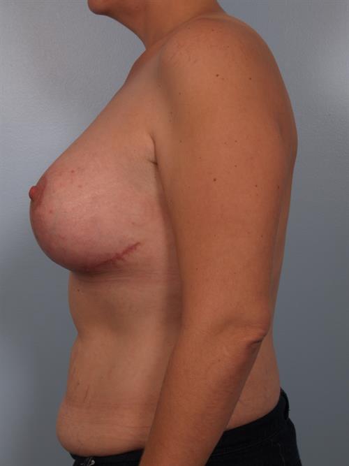 Revision Breast Surgery After Photo | Phoenix and Scottsdale, AZ | Scottsdale Center for Plastic Surgery