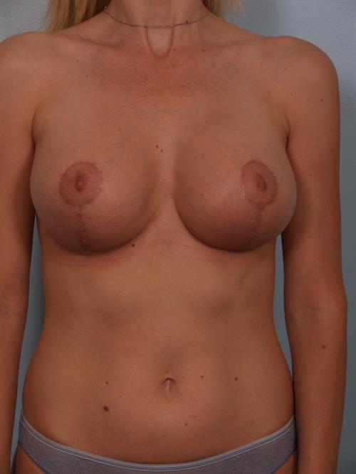 Revision Breast Surgery After Photo | Phoenix and Scottsdale, AZ | Scottsdale Center for Plastic Surgery