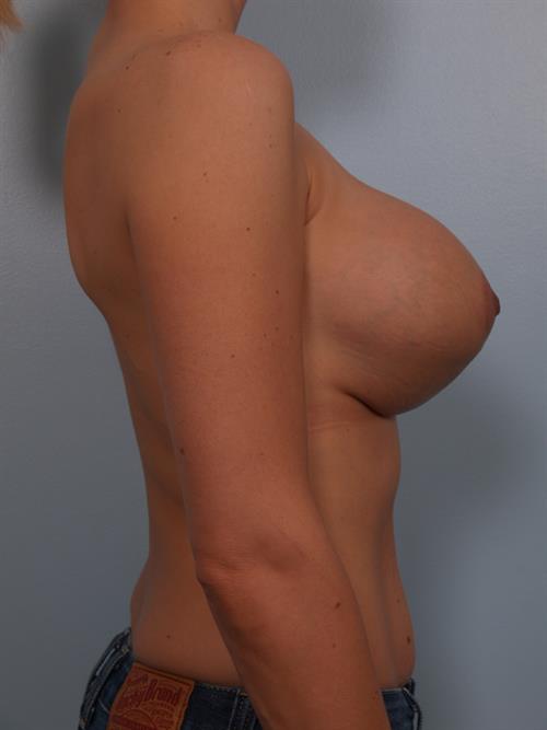 Revision Breast Surgery Before Photo | Phoenix and Scottsdale, AZ | Scottsdale Center for Plastic Surgery