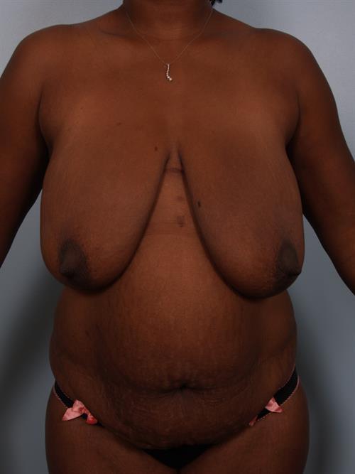 Tummy Tuck Before Photo | Phoenix and Scottsdale, AZ | Scottsdale Center for Plastic Surgery