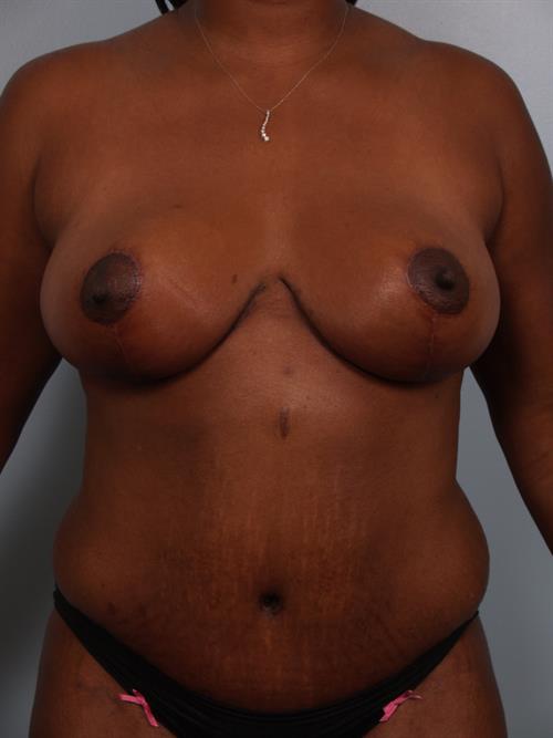 Tummy Tuck After Photo | Phoenix and Scottsdale, AZ | Scottsdale Center for Plastic Surgery