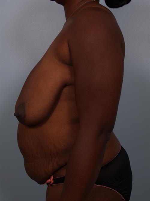 Tummy Tuck Before Photo | Phoenix and Scottsdale, AZ | Scottsdale Center for Plastic Surgery