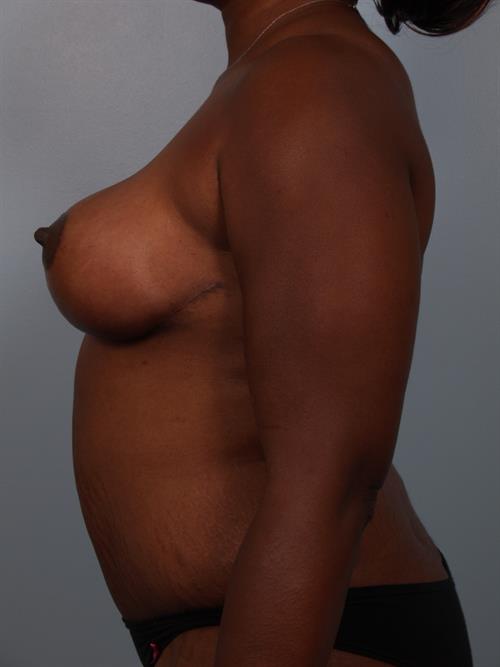 Tummy Tuck After Photo | Phoenix and Scottsdale, AZ | Scottsdale Center for Plastic Surgery