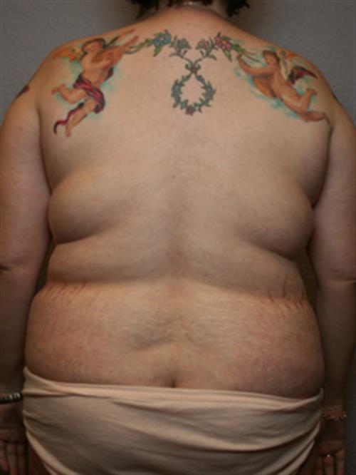 Power Assisted Liposuction Before Photo | Phoenix and Scottsdale, AZ | Scottsdale Center for Plastic Surgery