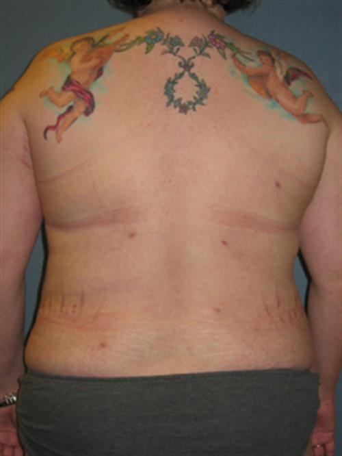 Power Assisted Liposuction After Photo | Phoenix and Scottsdale, AZ | Scottsdale Center for Plastic Surgery