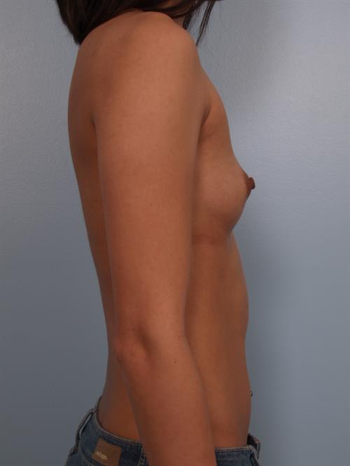 Breast Augmentation Before Photo | Phoenix and Scottsdale, AZ | Scottsdale Center for Plastic Surgery